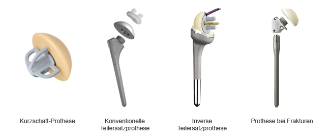 Verschiedene Arten von Schulterprothesen, die in der Abteilung Orthopädie und Unfallchirurgie im Sankt Marien-Krankenhaus Berlin verwendet werden